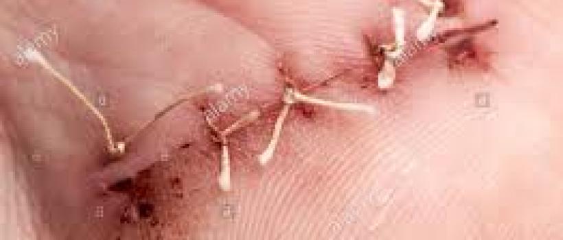 Surgical Sutures Market