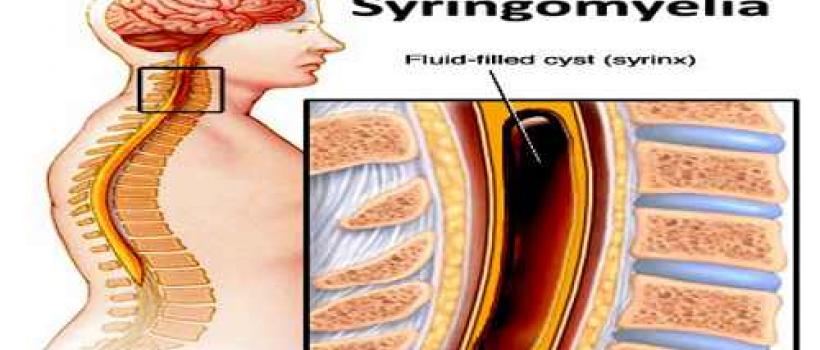 Syringomyelia Market 