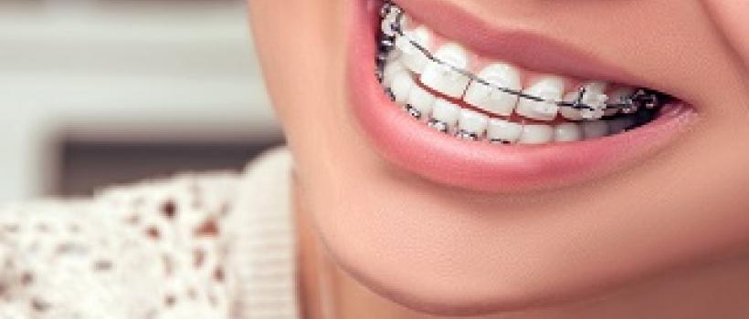 Teeth Straightening In Mumbai