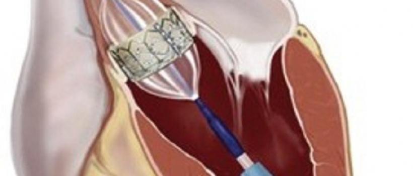 Transcatheter Aortic Valve Replacement/Implantation Market