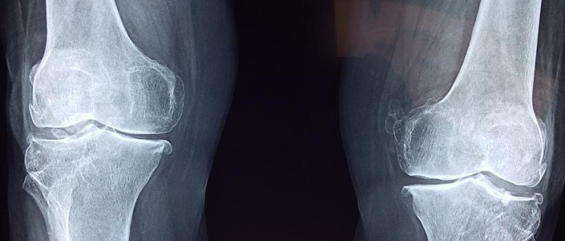 Uterine Sarcoma Treatment Market