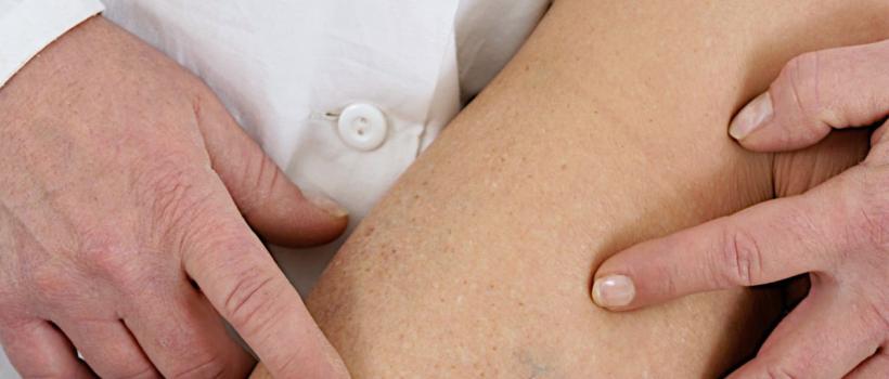  Varicose Vein Treatment Devices Market