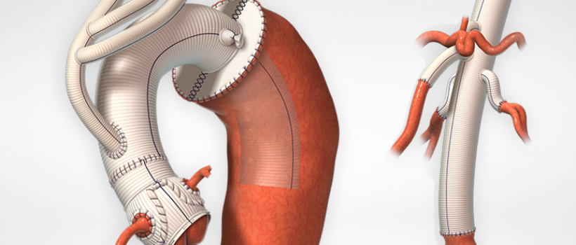Global Vascular Patches Market 