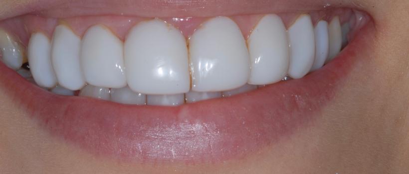 Getting Porcelain Veneers