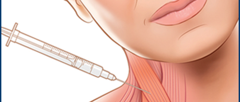 cervical dystonia management market