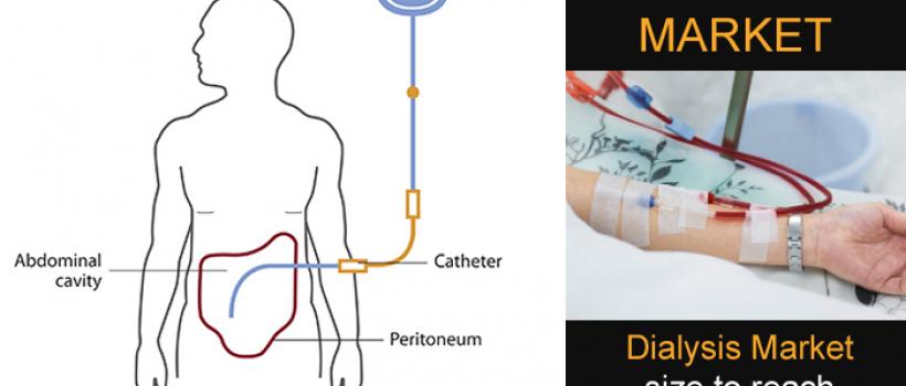 Global Dialysis Market- KBV Research