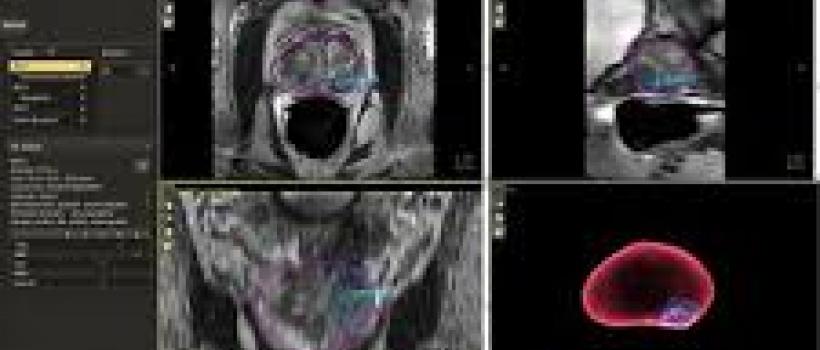 Global Prostate Cancer Diagnostics Market