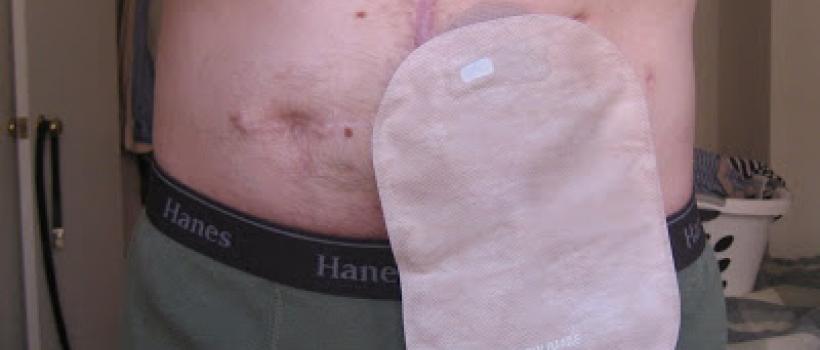 Global Stoma/Ostomy Care Market