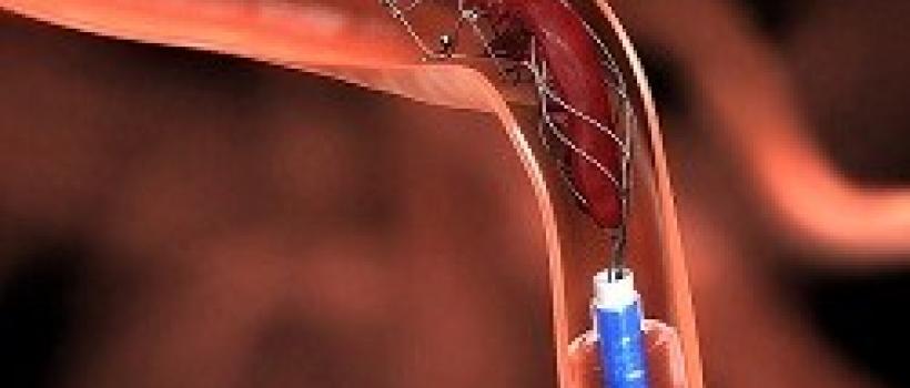 Global Thrombectomy Devices Market