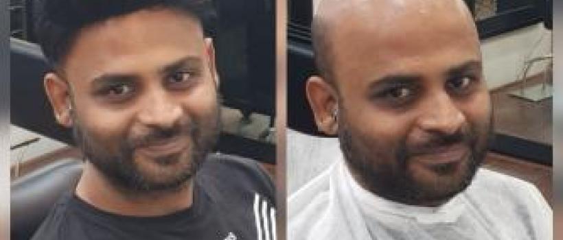 Non Surgical Hair Replacement in Mumbai