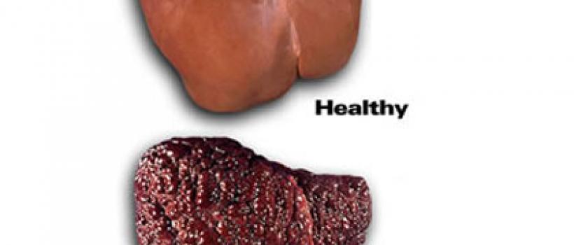 AyurvedictreatmentlivercirrhosisIndia, LivercirrhosistreatmentAyurvedaIndia, LivercirrhosisayurvedictreatmentNagpur, Ayurvedicmedicinelivercirrhosis,Herbalmedicinecirrhosisofliver ,Livercirrhosisnaturaltreatment