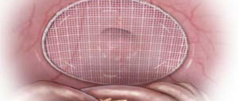 Hernia Repair Market Size