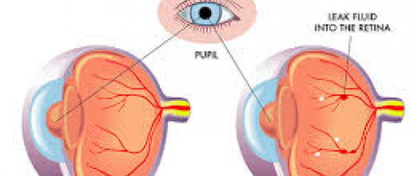 Diabetic Retinopathy