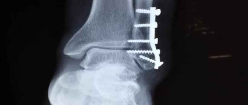 Joint Reconstruction Devices And Equipment Market