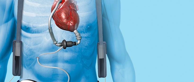 Cardiac Assist Devices Market