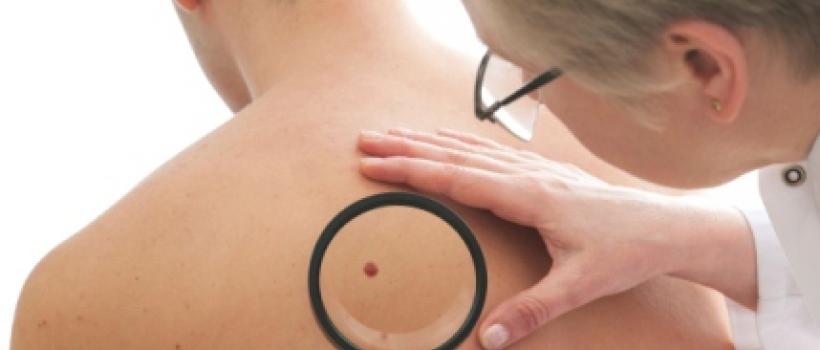 Melanoma Therapeutics Market