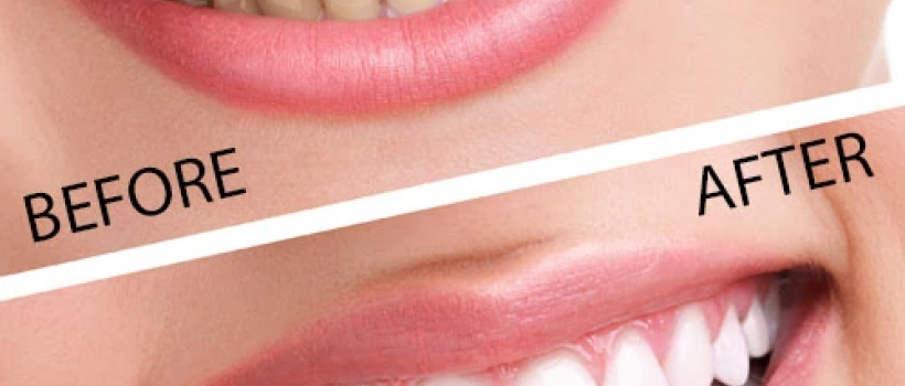 Teeth Whitening