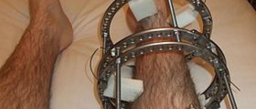 Osteosynthesis Internal Fixation Devices