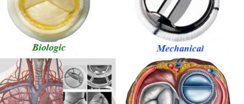 Prosthetic Heart Valves