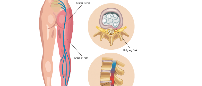 ArthritisTreatmentCenterNagpur, RheumatoidArthritisSymptoms, WhatCausesArthritis ,RheumatoidArthritisTreatmentNagpur , RheumatoidArthritisMedicationsNagpur ,ArthritisRemediesNagpur,AyurvedicTreatmentArthritisNagpur ,AyurvedicTreatmentKneePainSwellingNagpur , Ayurvedic TreatmentKneeArthritisNagpur, RheumatoidArthritisNaturalTreatmentNagpur, AchillesTendonInjuryTreatmentNagpur, AchillesTendonitistreatmentNagpur,AchillesTendonPainTreatmentNagpur , Achilles HeelPainNagpur, AyurvedicTreatmentMeniscusTearNagpur, 