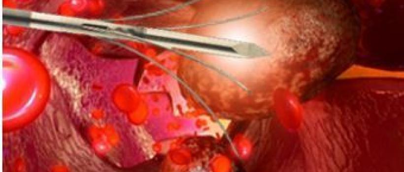 Europe Tumor Ablation Market