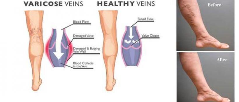 Varicose Veins Treatment Market