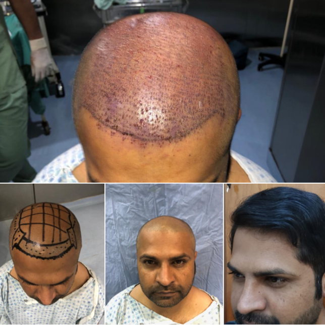 Hair Transplant results by Dr.Abdul Malik Plastic Surgeon In Lahore