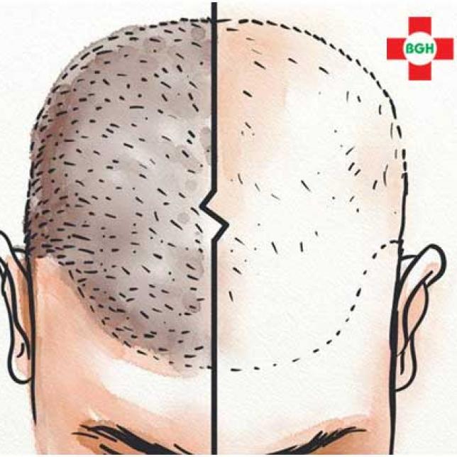 Hair transplant