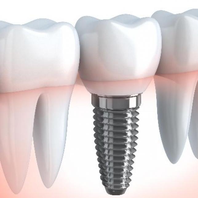 global bio-implants market