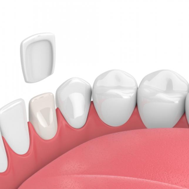  Dental Veneers Haverhill MA
