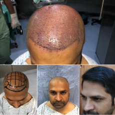 Hair Transplant results by Dr.Abdul Malik Plastic Surgeon In Lahore